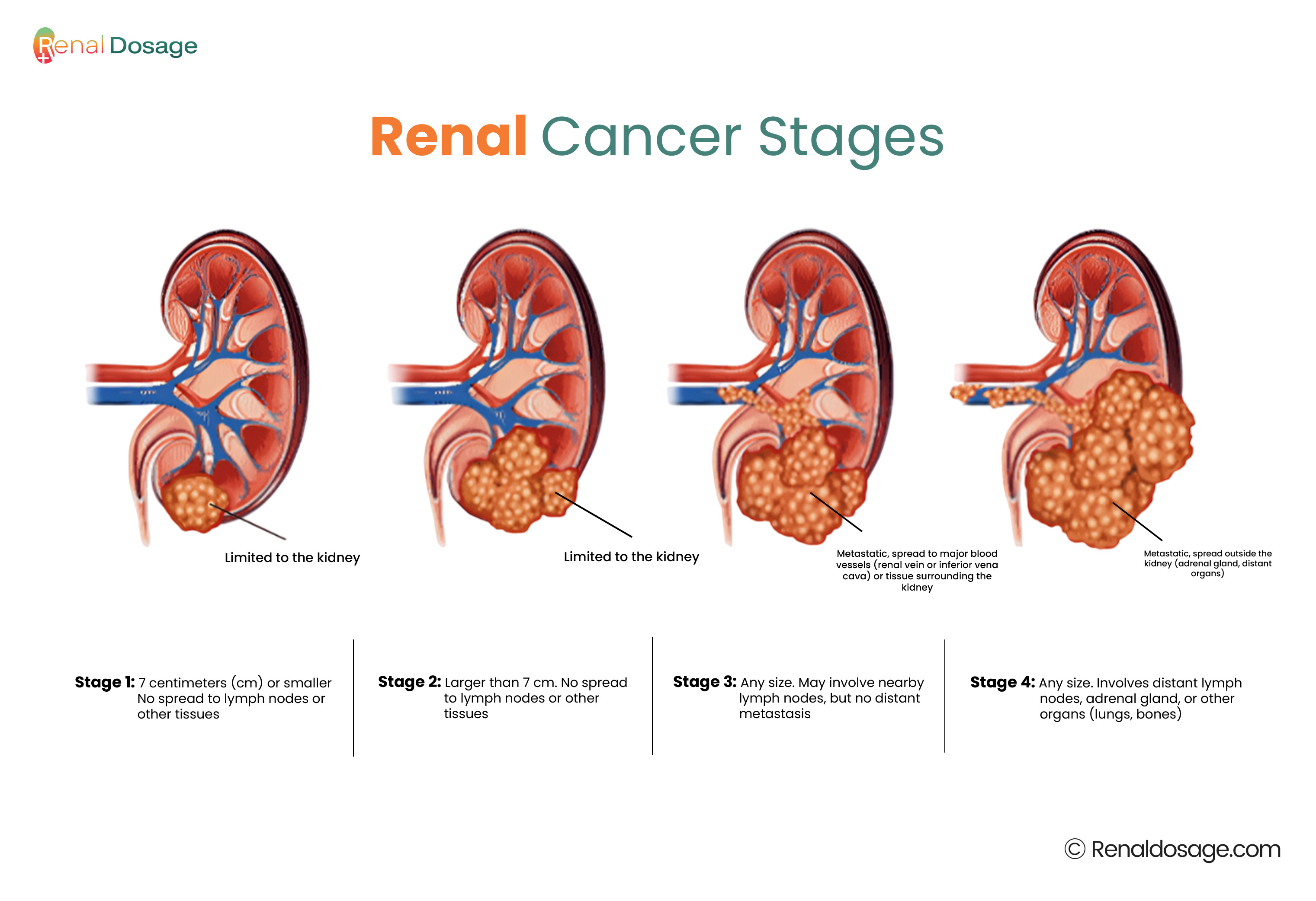 Kidney Cancer Stages